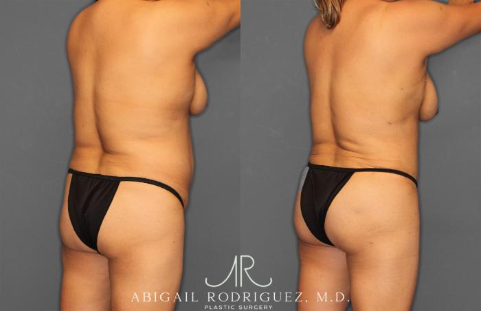 Before & After Tummy Tuck Case 257464 View 7 View in Houston, TX