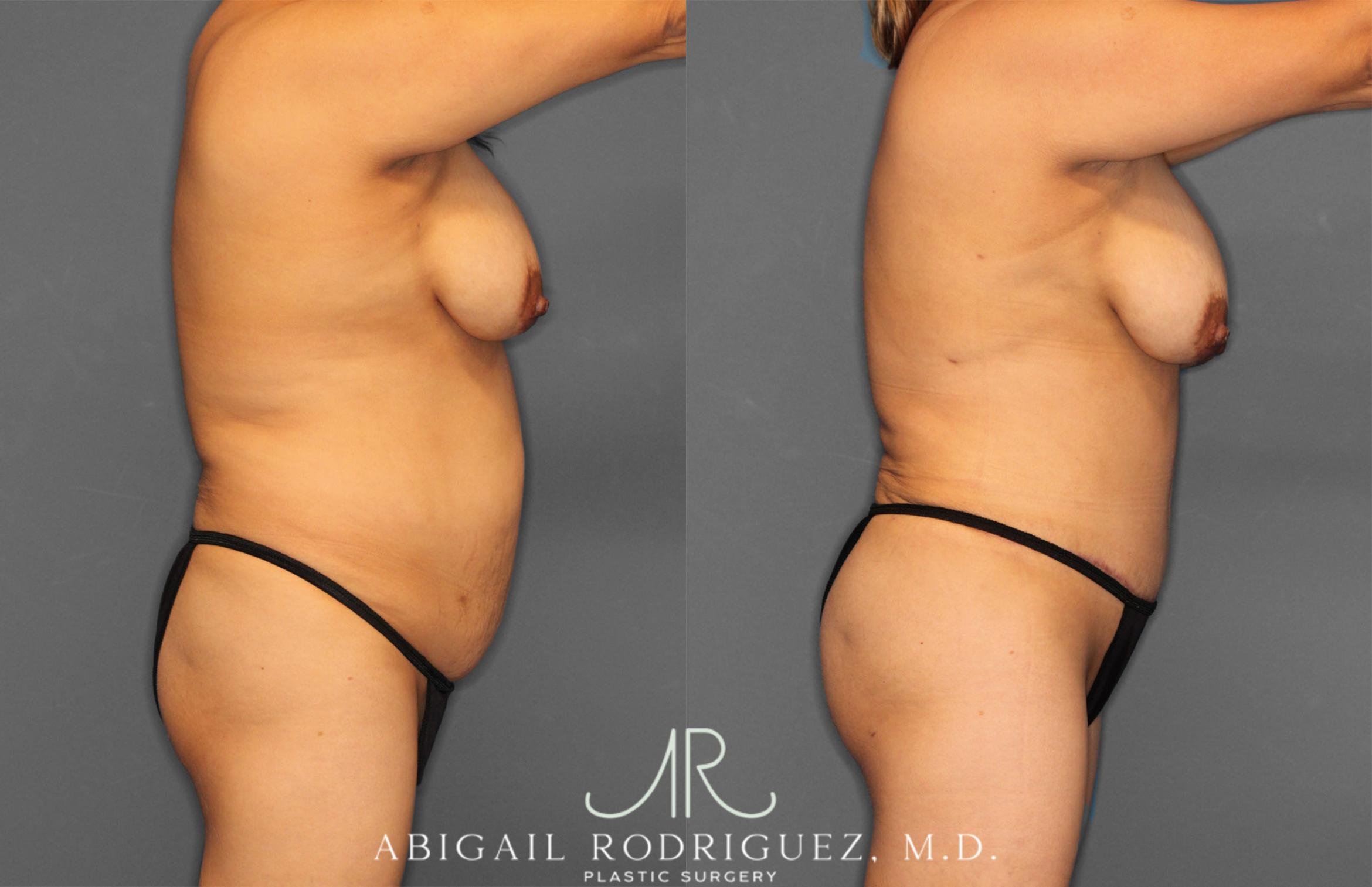 Before & After Tummy Tuck Case 257464 View 8 View in Houston, TX