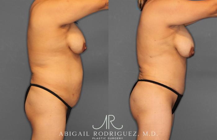 Before & After Tummy Tuck Case 257464 View 8 View in Houston, TX