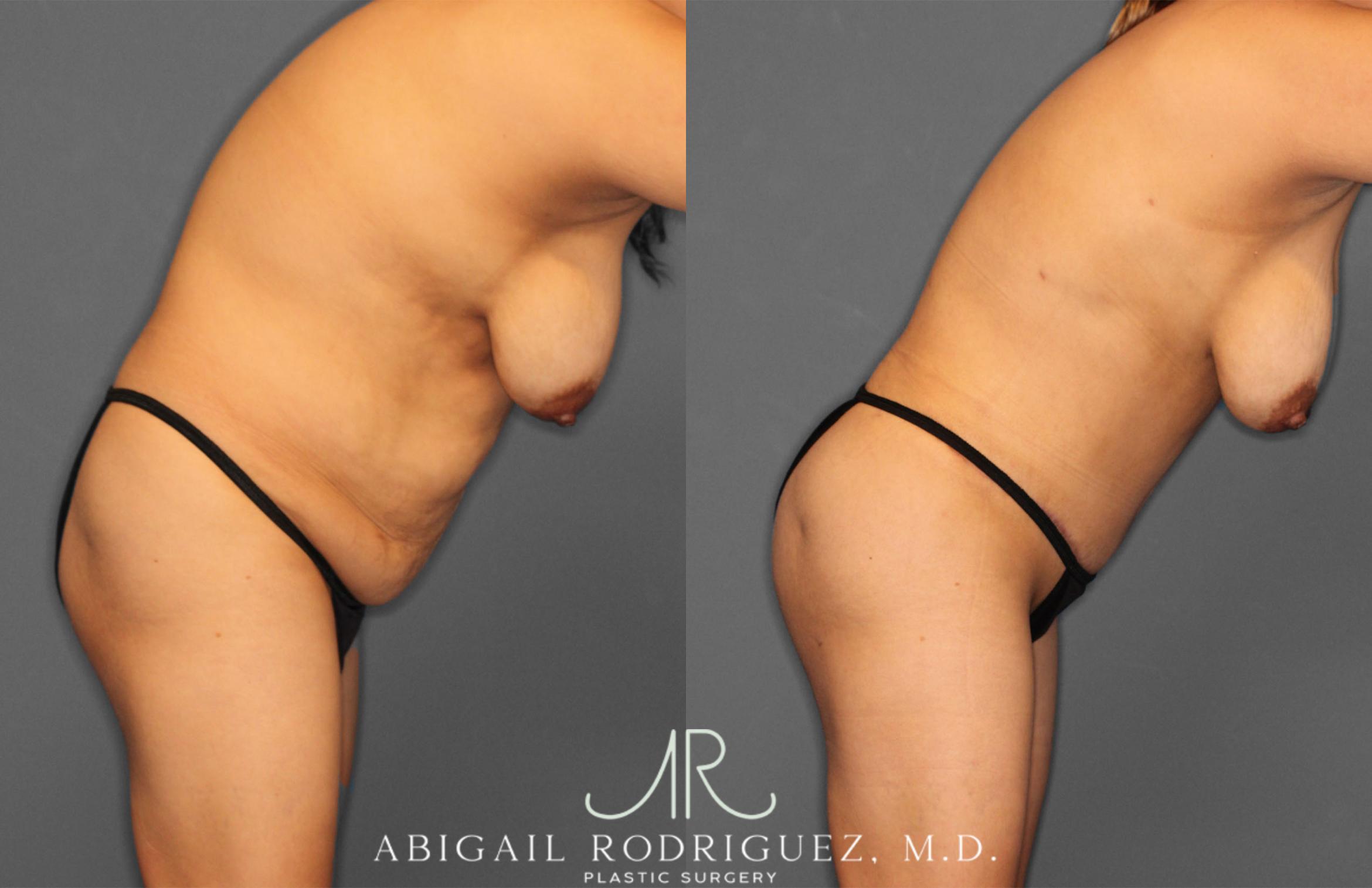 Before & After Tummy Tuck Case 257464 View 9 View in Houston, TX