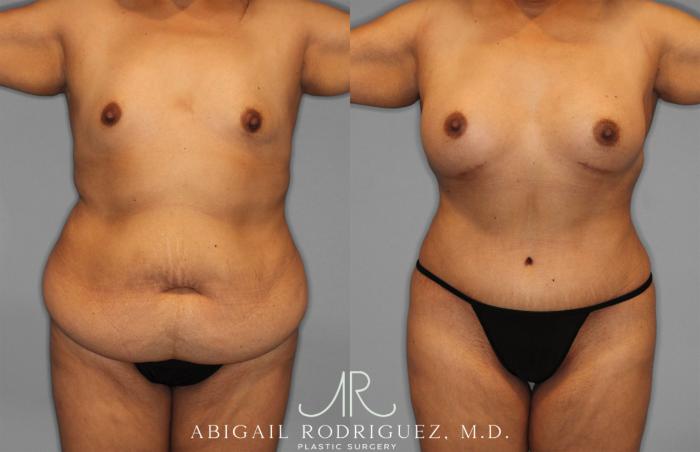 Before & After Tummy Tuck Case 257500 View 1 View in Houston, TX