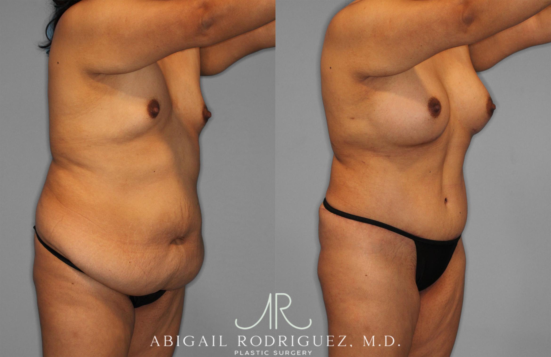 Before & After Tummy Tuck Case 257500 View 10 View in Houston, TX