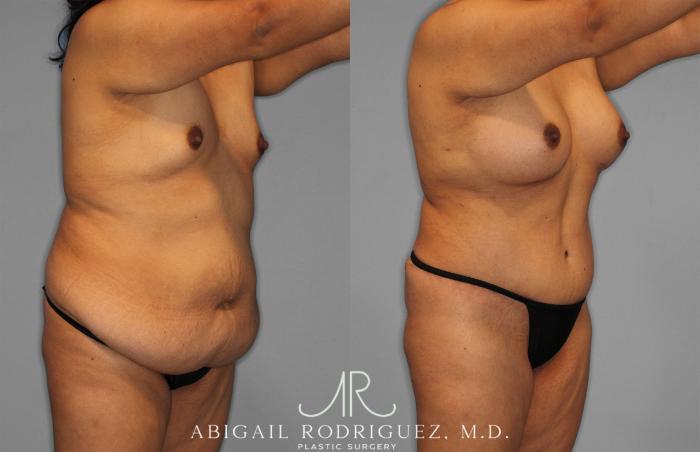 Before & After Tummy Tuck Case 257500 View 10 View in Houston, TX