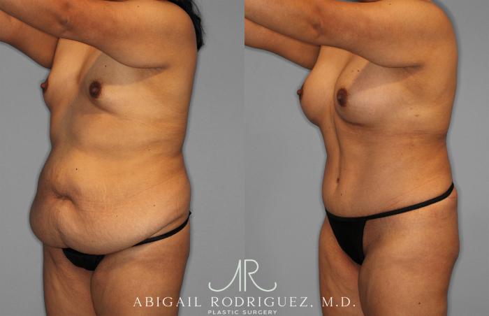 Before & After Tummy Tuck Case 257500 View 2 View in Houston, TX