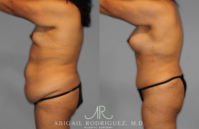 Before & After Tummy Tuck Case 257500 View 3 View in Houston, TX