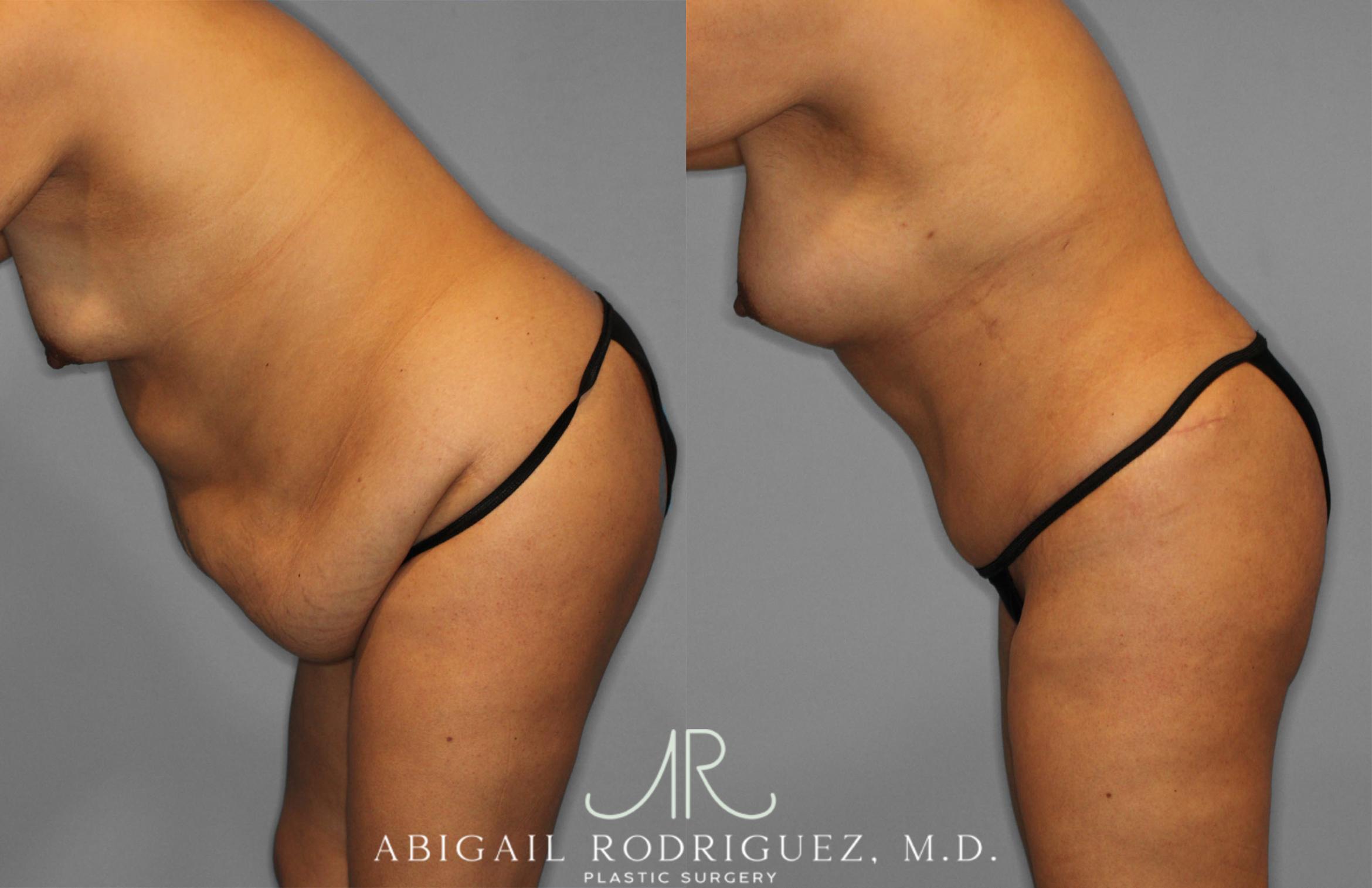 Before & After Tummy Tuck Case 257500 View 4 View in Houston, TX