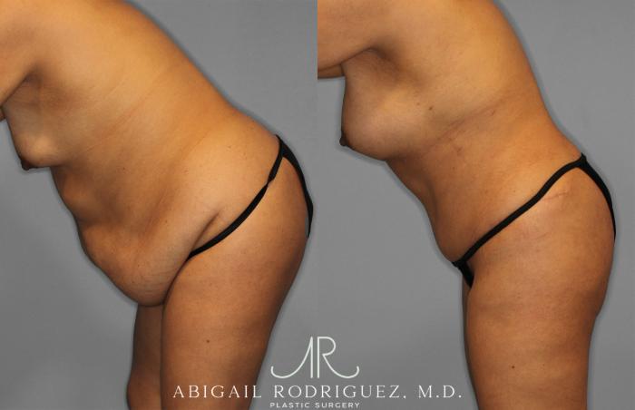 Before & After Tummy Tuck Case 257500 View 4 View in Houston, TX