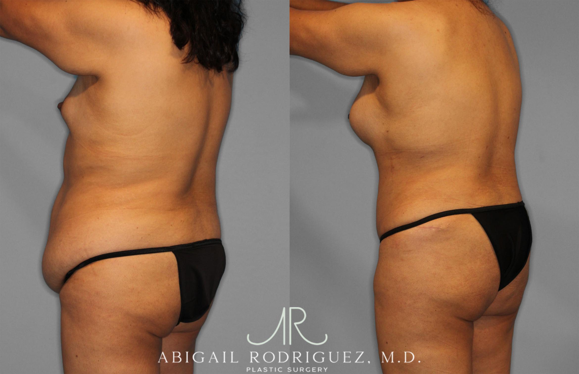 Before & After Tummy Tuck Case 257500 View 5 View in Houston, TX
