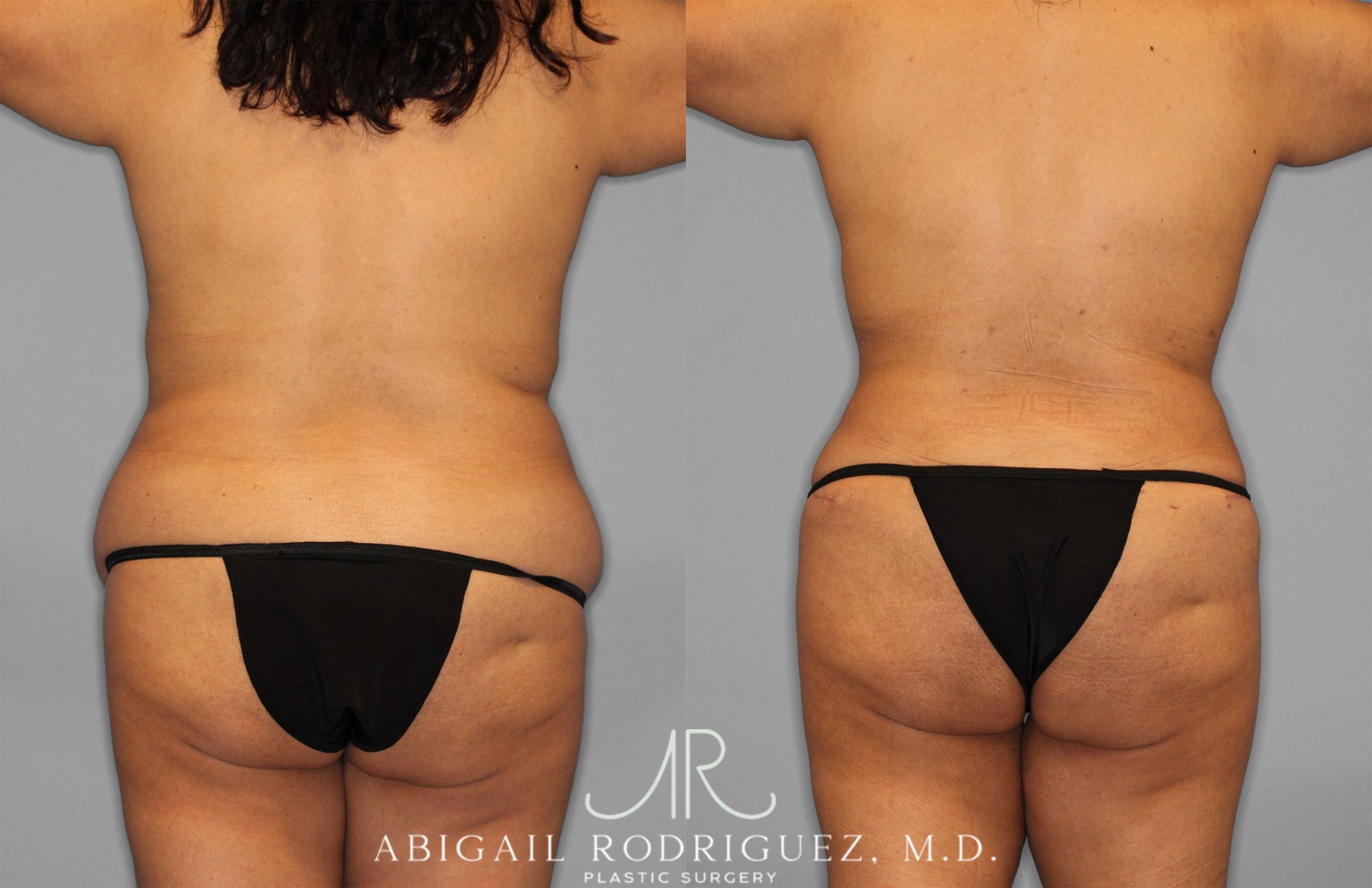 Before & After Tummy Tuck Case 257500 View 6 View in Houston, TX