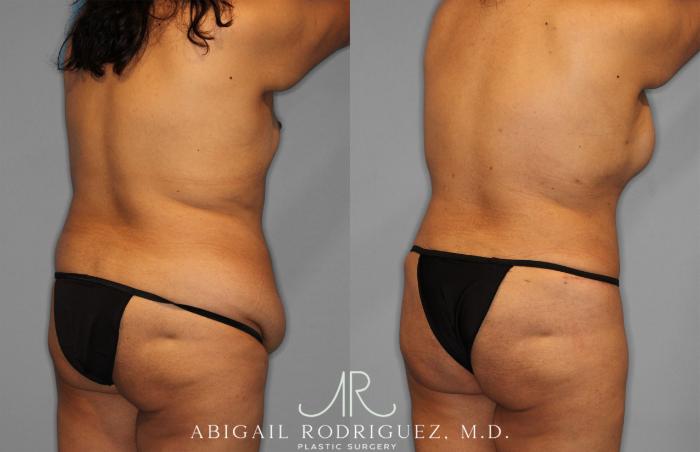 Before & After Tummy Tuck Case 257500 View 7 View in Houston, TX