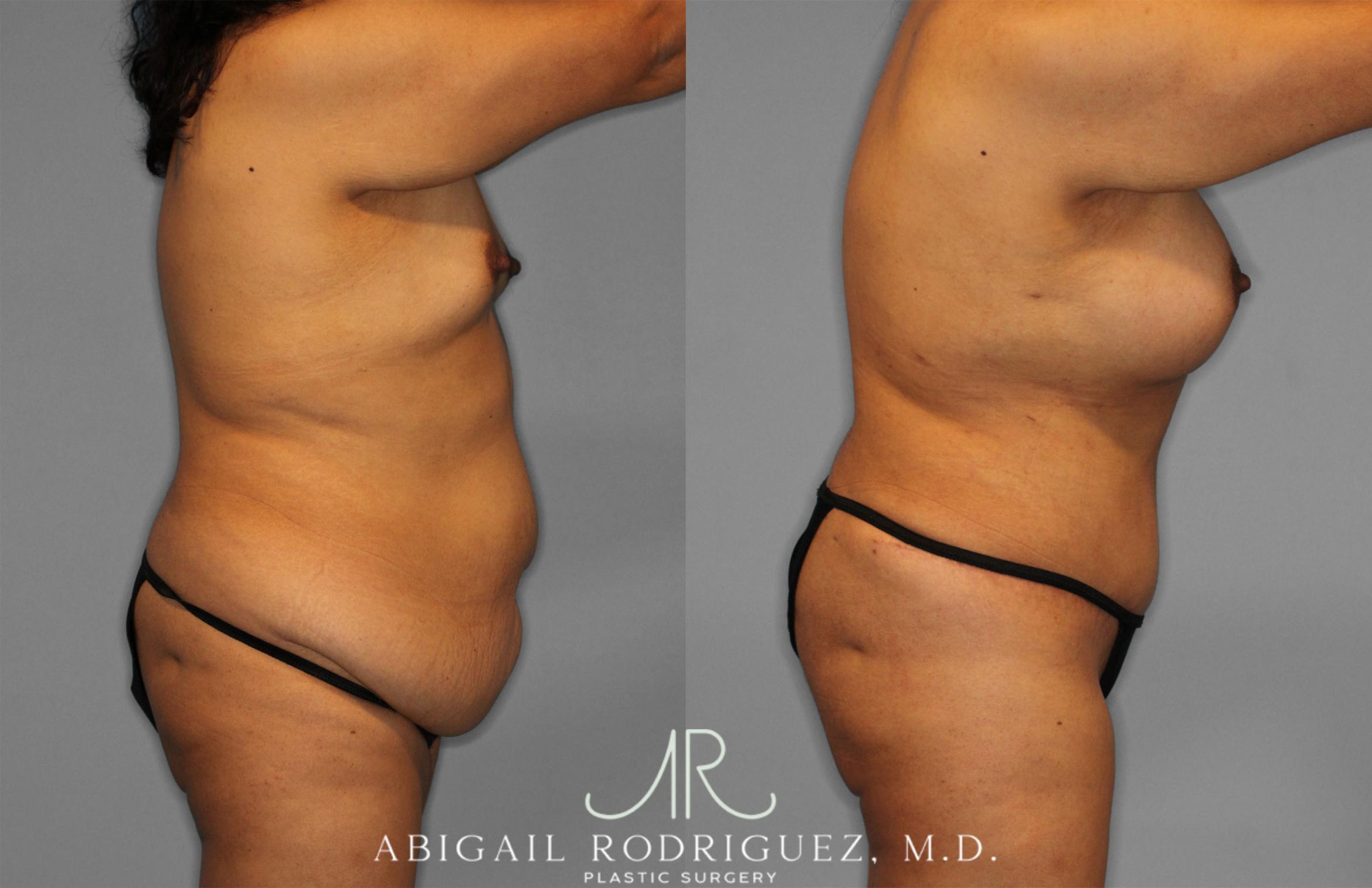 Before & After Tummy Tuck Case 257500 View 8 View in Houston, TX