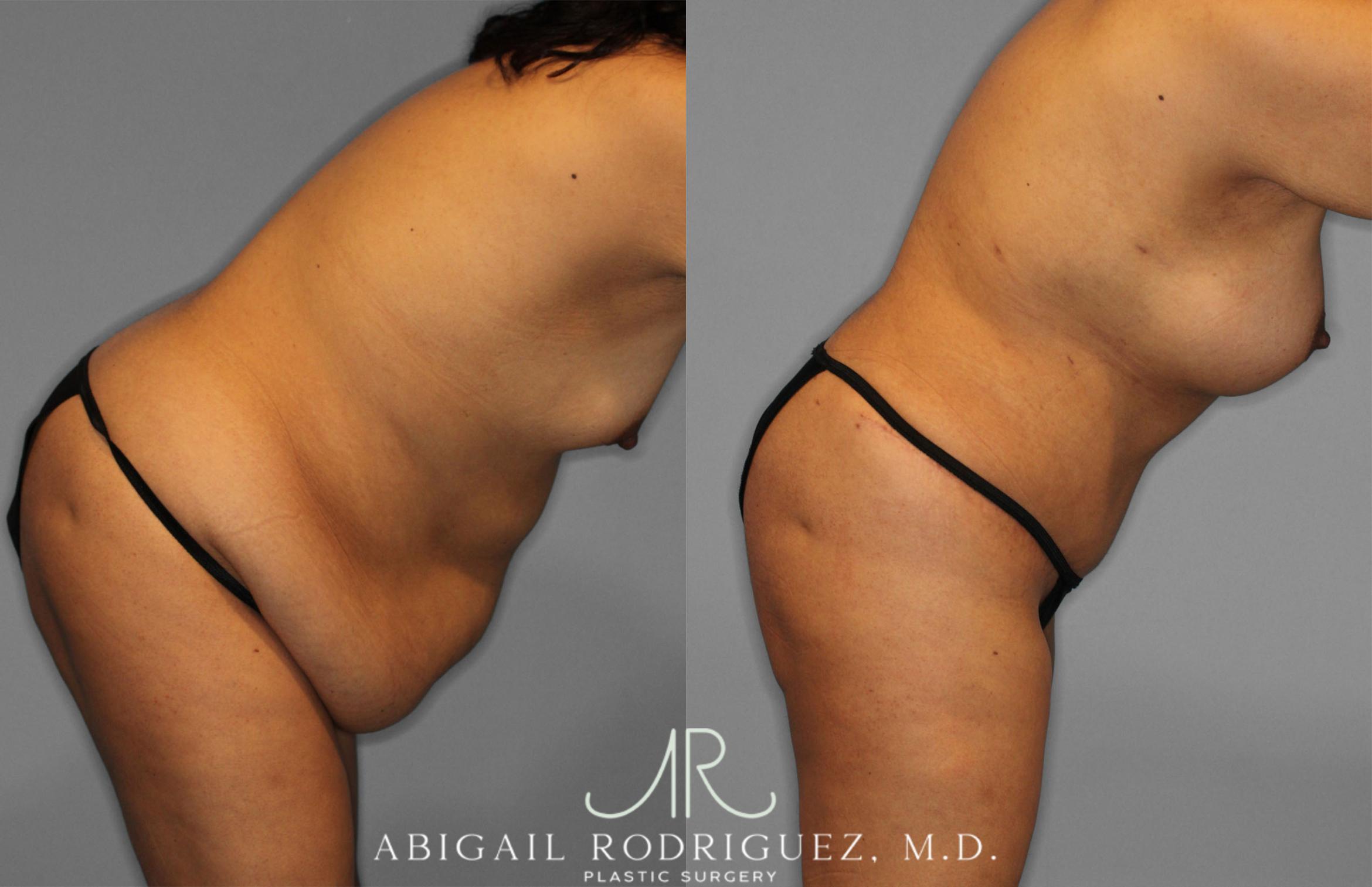 Before & After Tummy Tuck Case 257500 View 9 View in Houston, TX