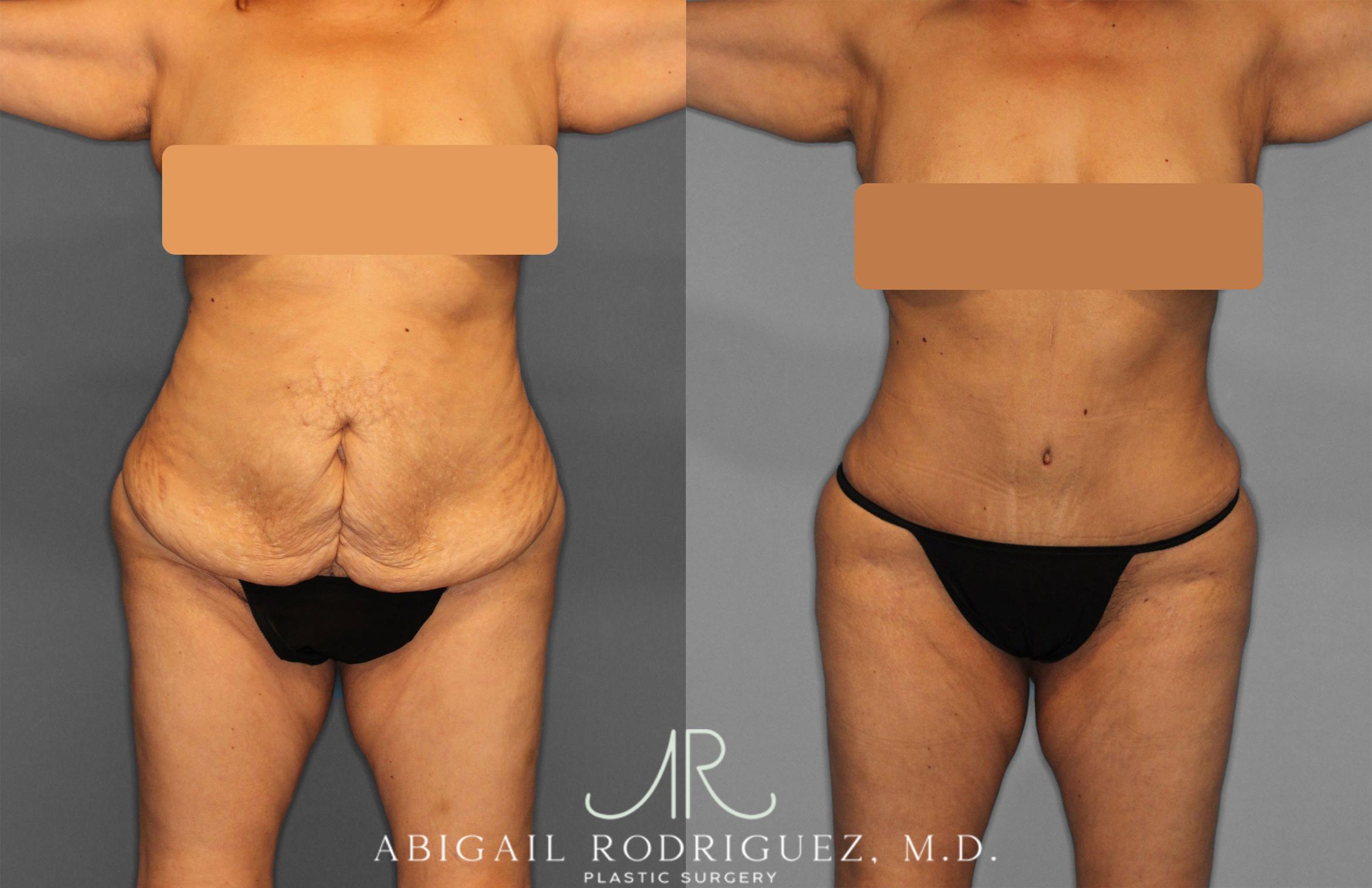 Before & After Tummy Tuck Case 257552 View 1 View in Houston, TX