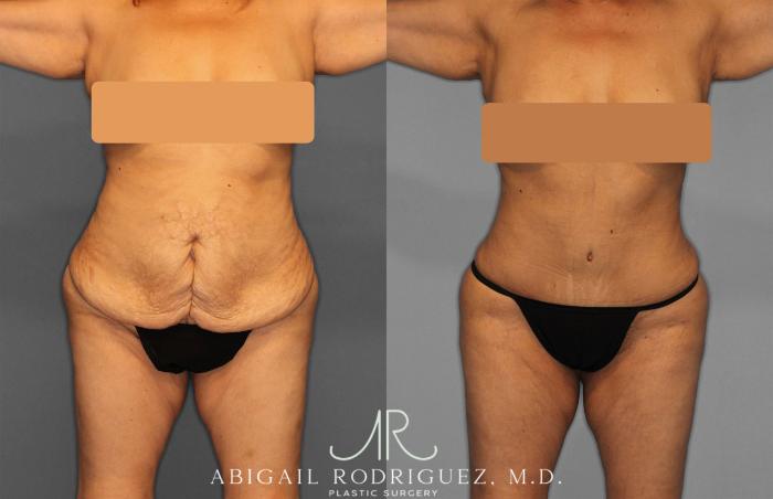 Before & After Liposuction Case 257552 View 1 View in Houston, TX