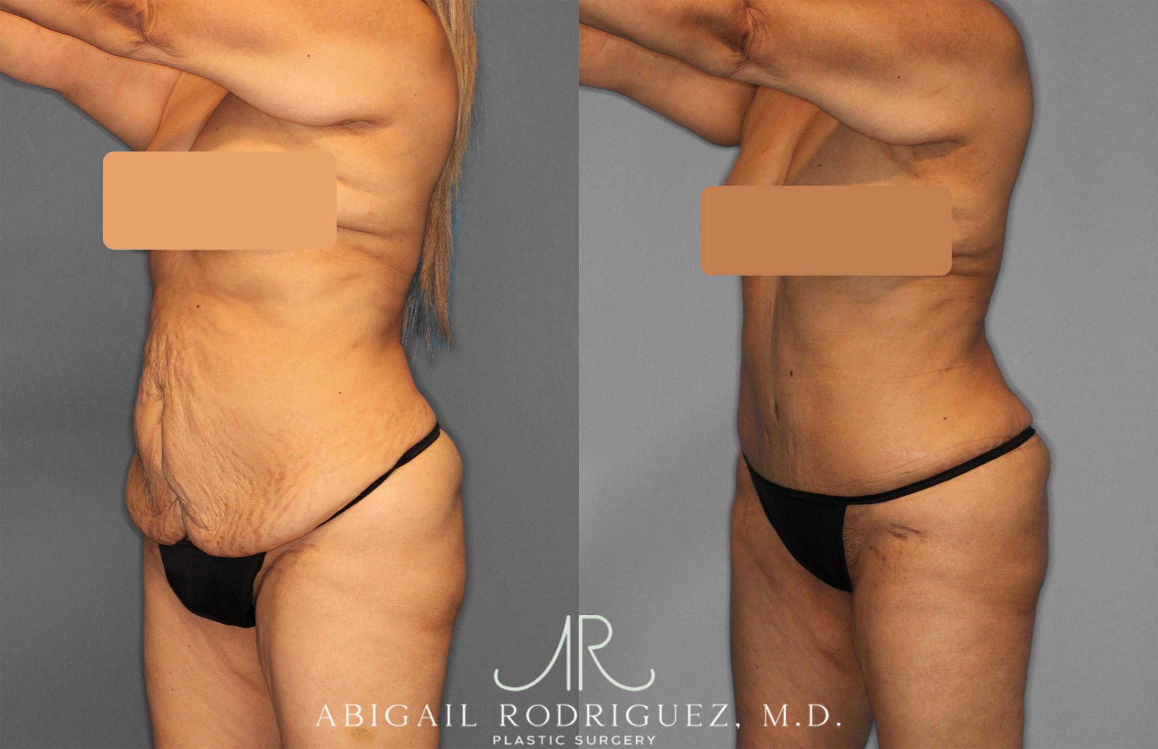 Before & After Tummy Tuck Case 257552 View 2 View in Houston, TX
