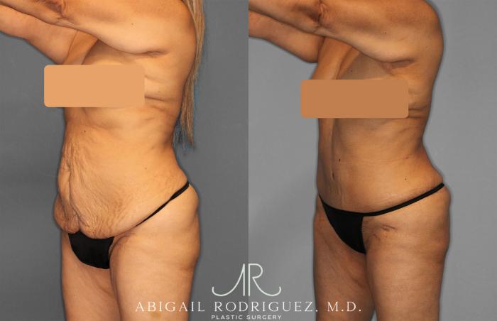 Before & After Tummy Tuck Case 257552 View 2 View in Houston, TX