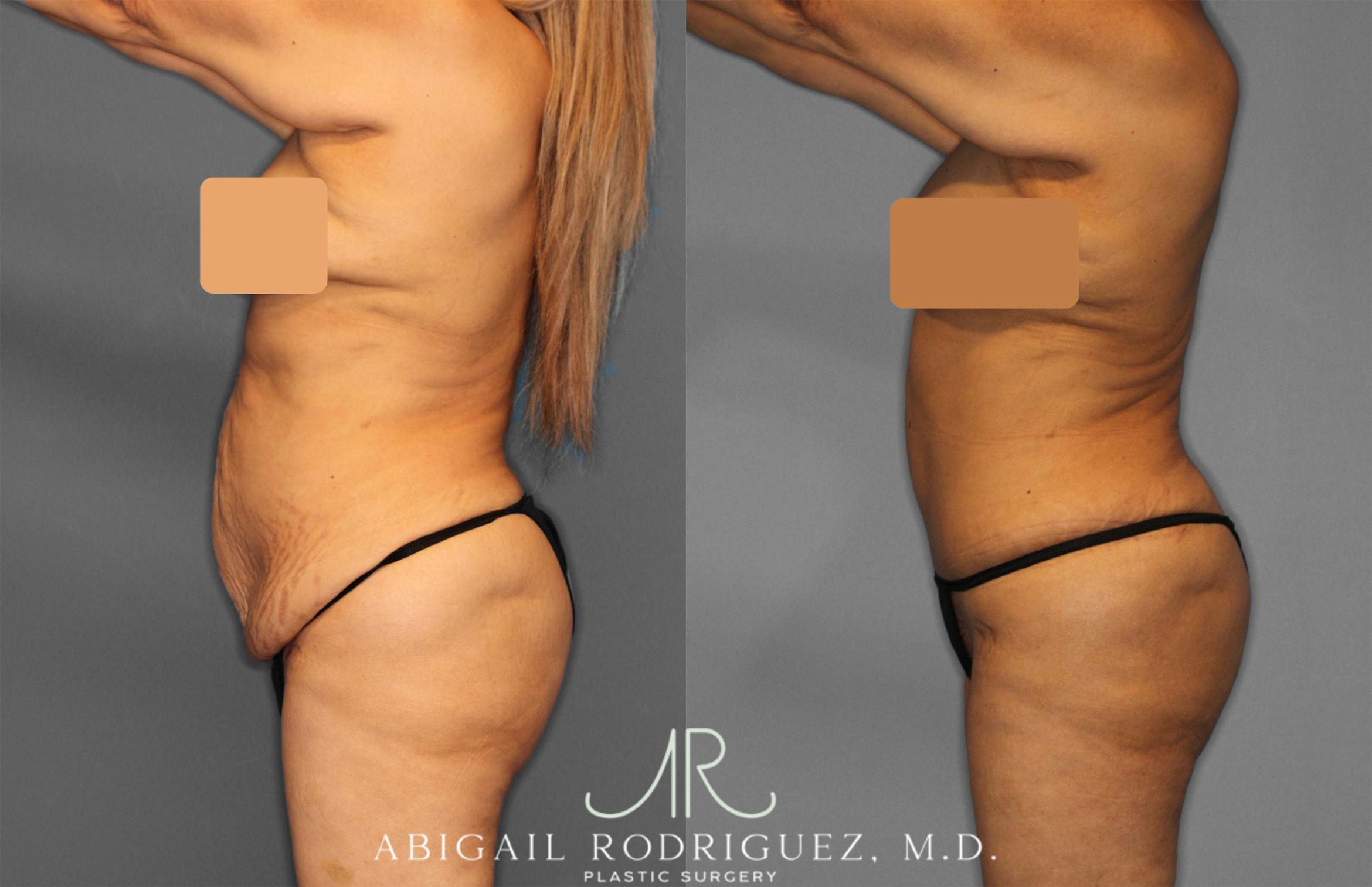 Before & After Tummy Tuck Case 257552 View 3 View in Houston, TX