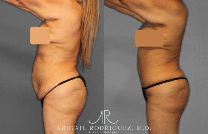 Before & After Tummy Tuck Case 257552 View 3 View in Houston, TX