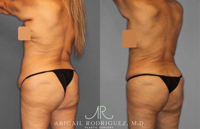 Before & After Tummy Tuck Case 257552 View 4 View in Houston, TX