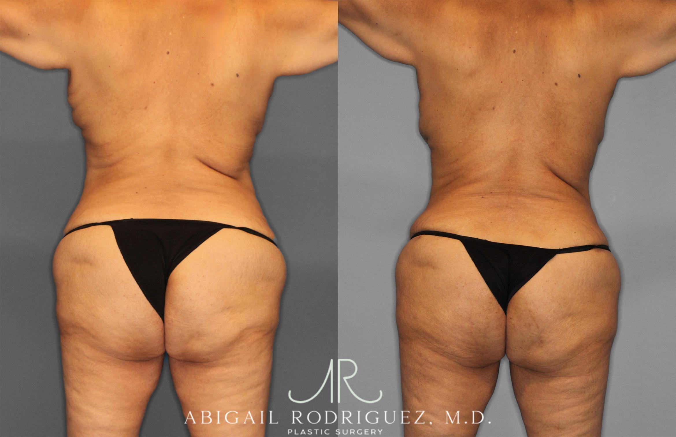 Before & After Tummy Tuck Case 257552 View 5 View in Houston, TX