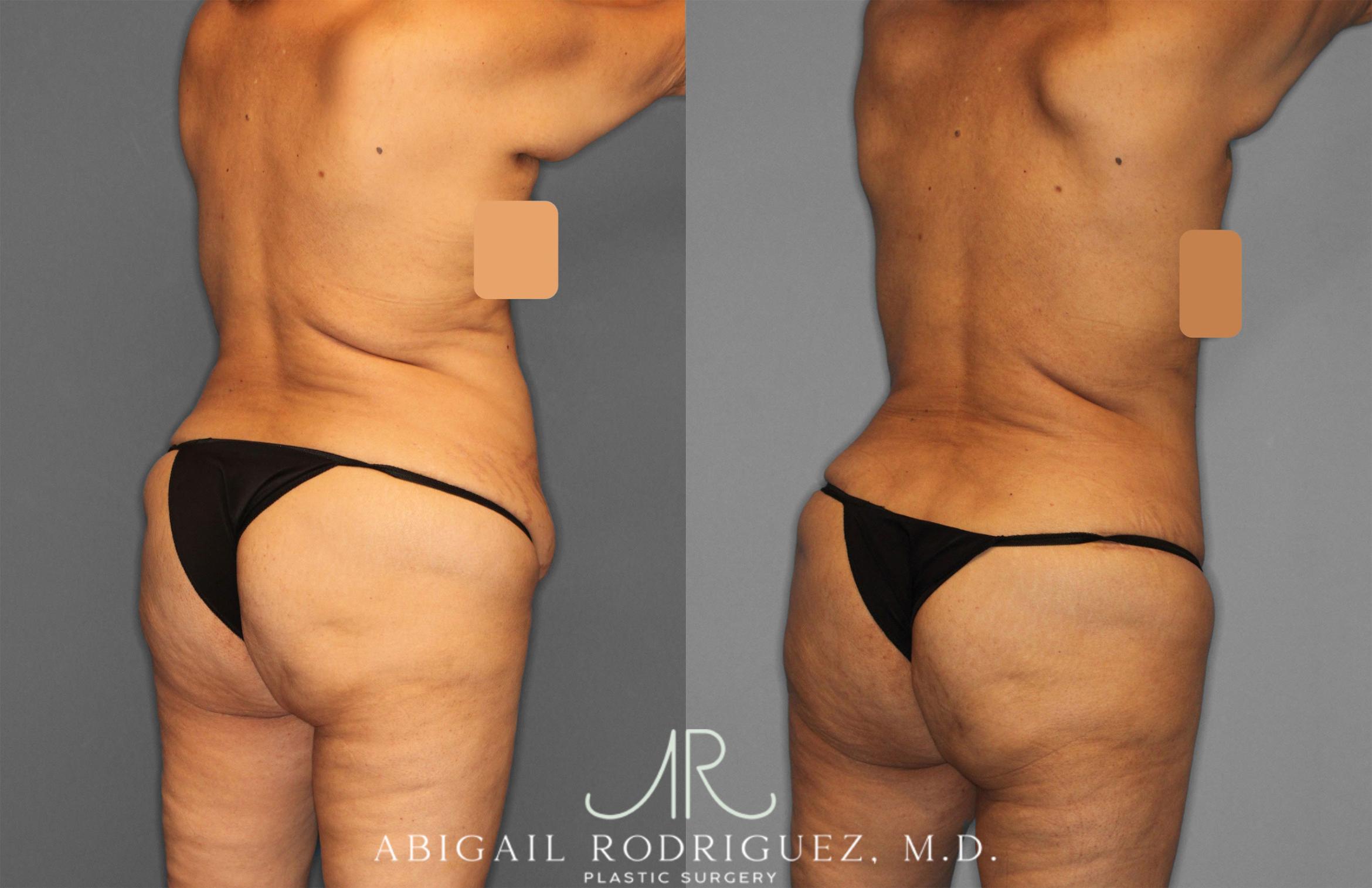 Before & After Tummy Tuck Case 257552 View 6 View in Houston, TX