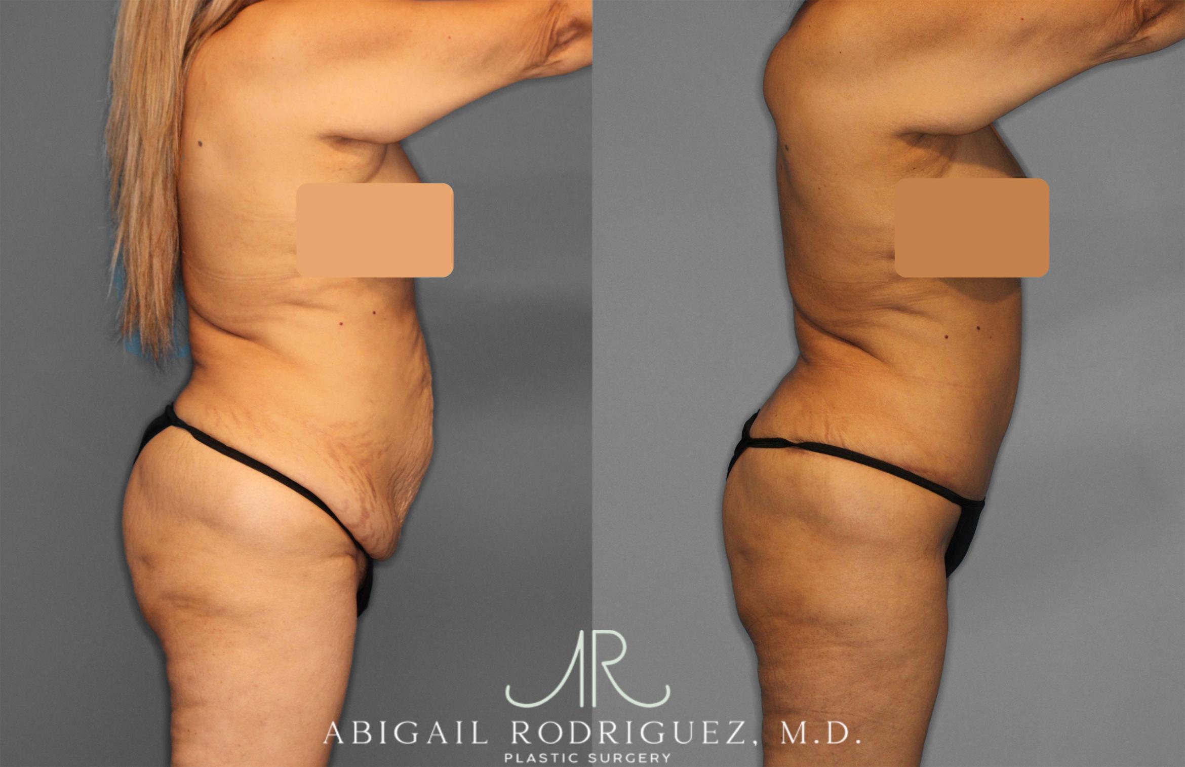 Before & After Tummy Tuck Case 257552 View 7 View in Houston, TX