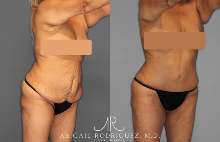 Before & After Tummy Tuck Case 257552 View 8 View in Houston, TX