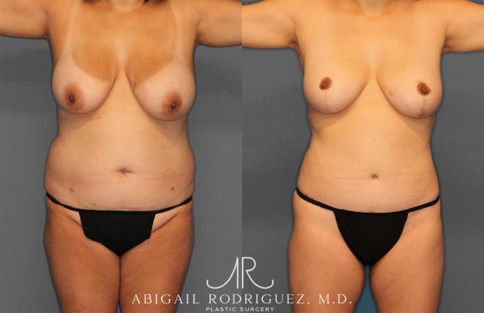 Before & After Tummy Tuck Case 258013 View 1 View in Houston, TX