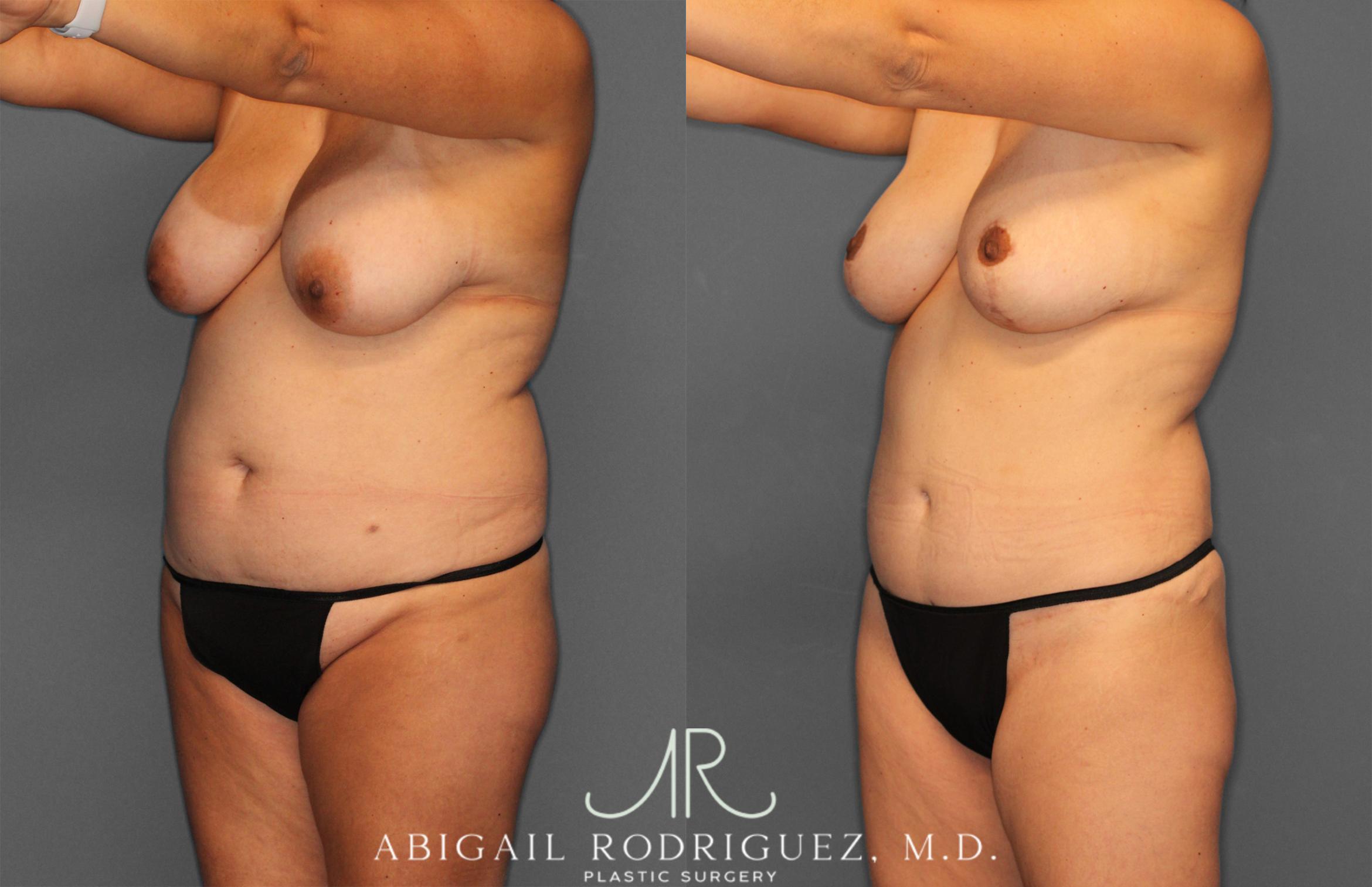 Before & After Tummy Tuck Case 258013 View 2 View in Houston, TX