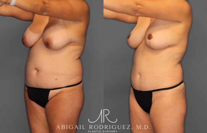 Before & After Tummy Tuck Case 258013 View 2 View in Houston, TX