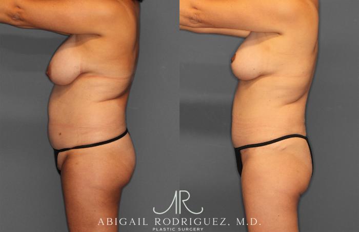 Before & After Tummy Tuck Case 258013 View 3 View in Houston, TX