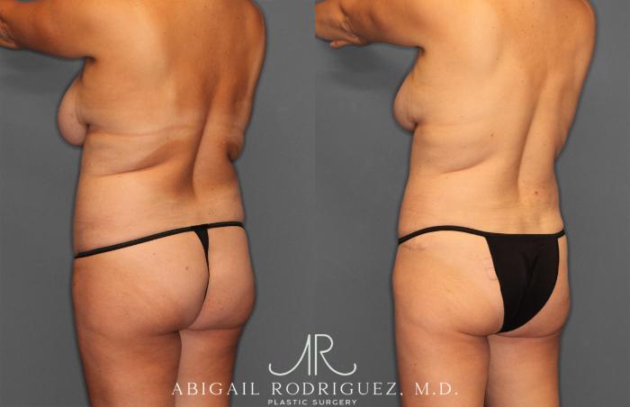 Before & After Tummy Tuck Case 258013 View 4 View in Houston, TX