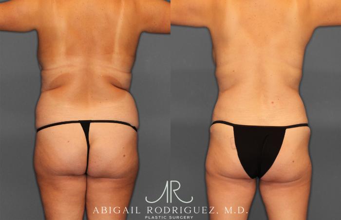 Before & After Tummy Tuck Case 258013 View 5 View in Houston, TX