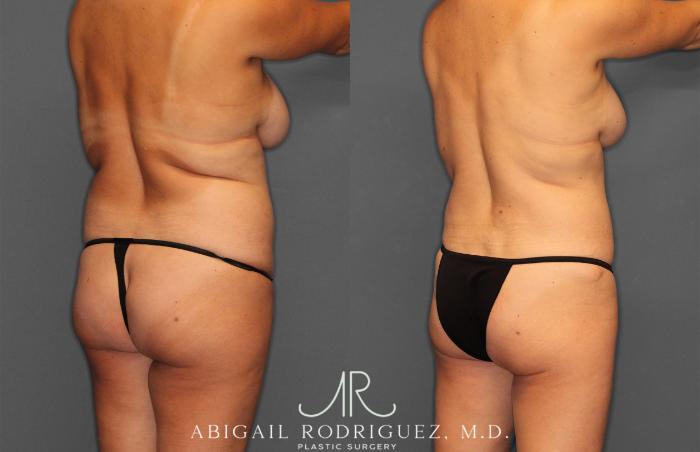 Before & After Tummy Tuck Case 258013 View 6 View in Houston, TX