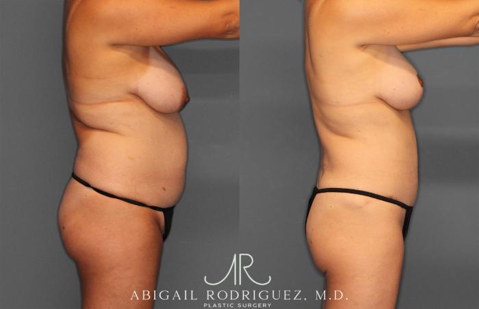 Before & After Tummy Tuck Case 258013 View 7 View in Houston, TX