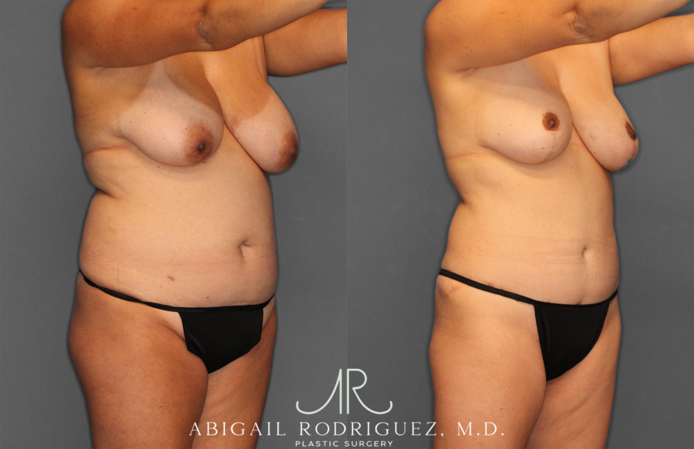 Before & After Tummy Tuck Case 258013 View 8 View in Houston, TX