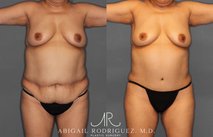 Before & After Tummy Tuck Case 258034 View 1 View in Houston, TX