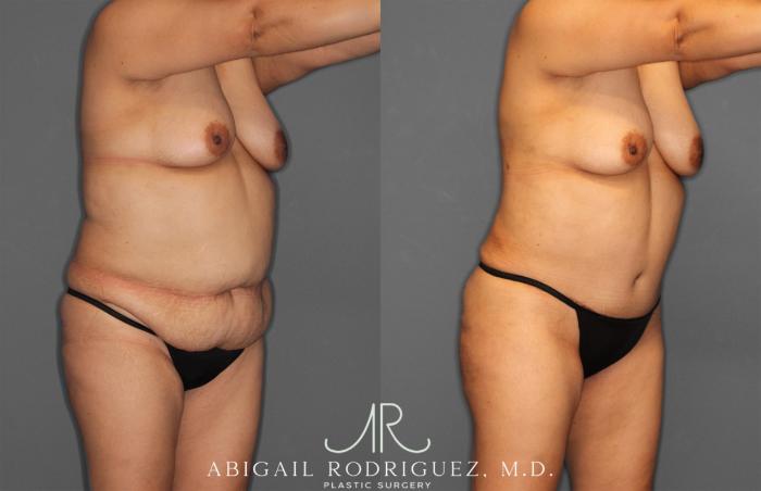 Before & After Tummy Tuck Case 258034 View 10 View in Houston, TX