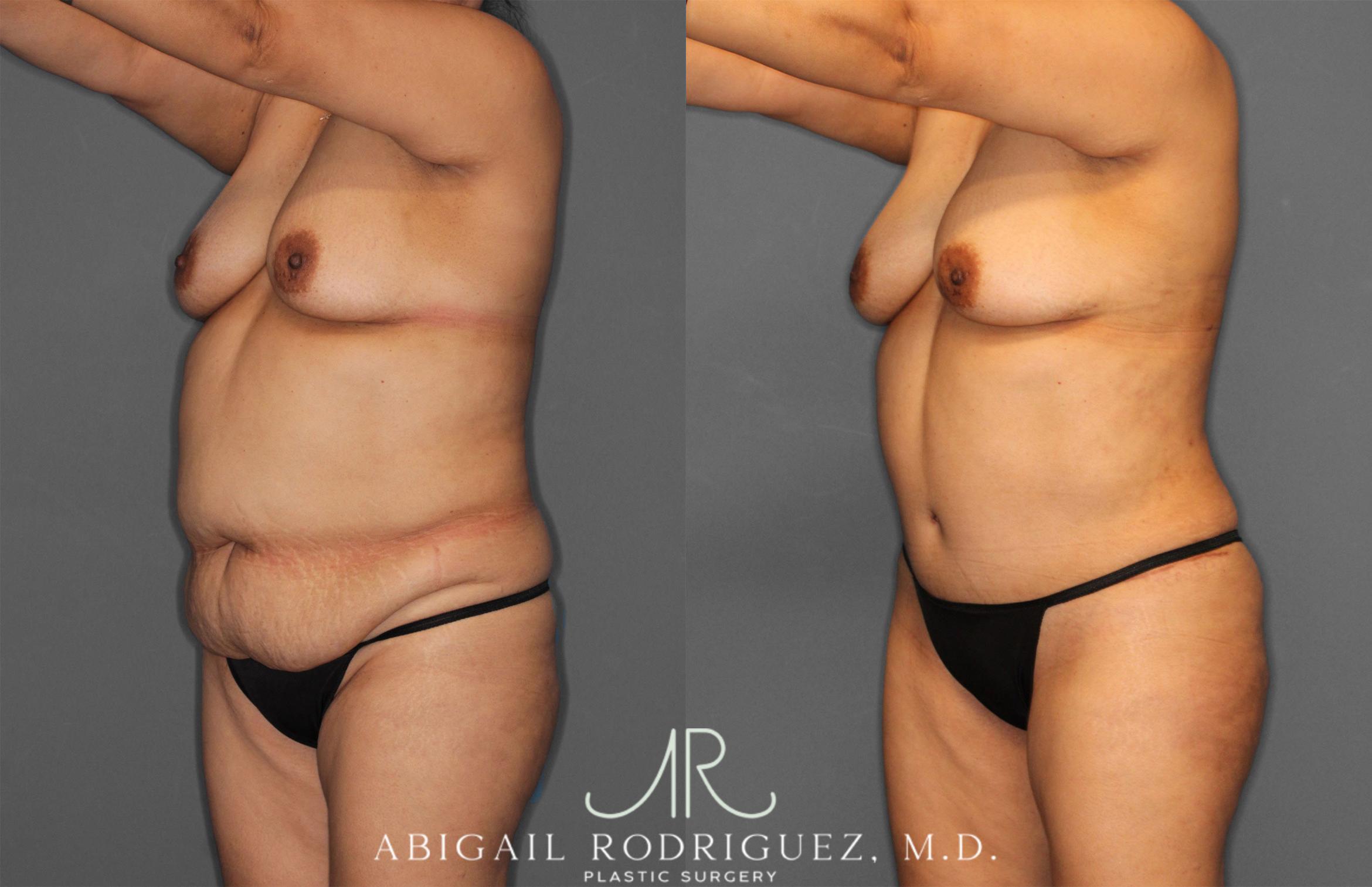 Before & After Tummy Tuck Case 258034 View 2 View in Houston, TX