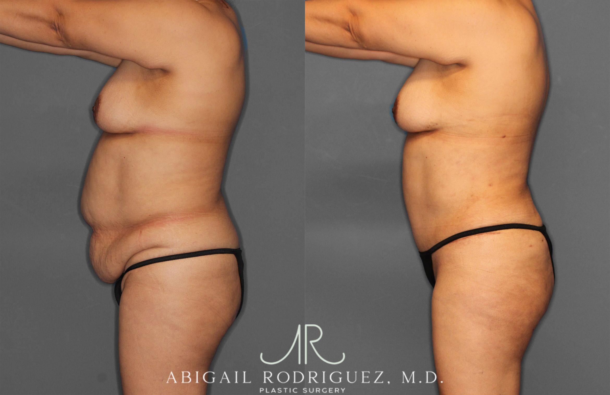 Before & After Tummy Tuck Case 258034 View 3 View in Houston, TX