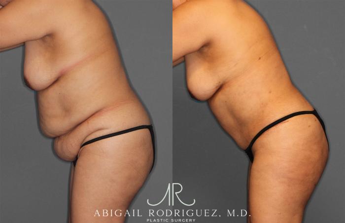 Before & After Tummy Tuck Case 258034 View 4 View in Houston, TX