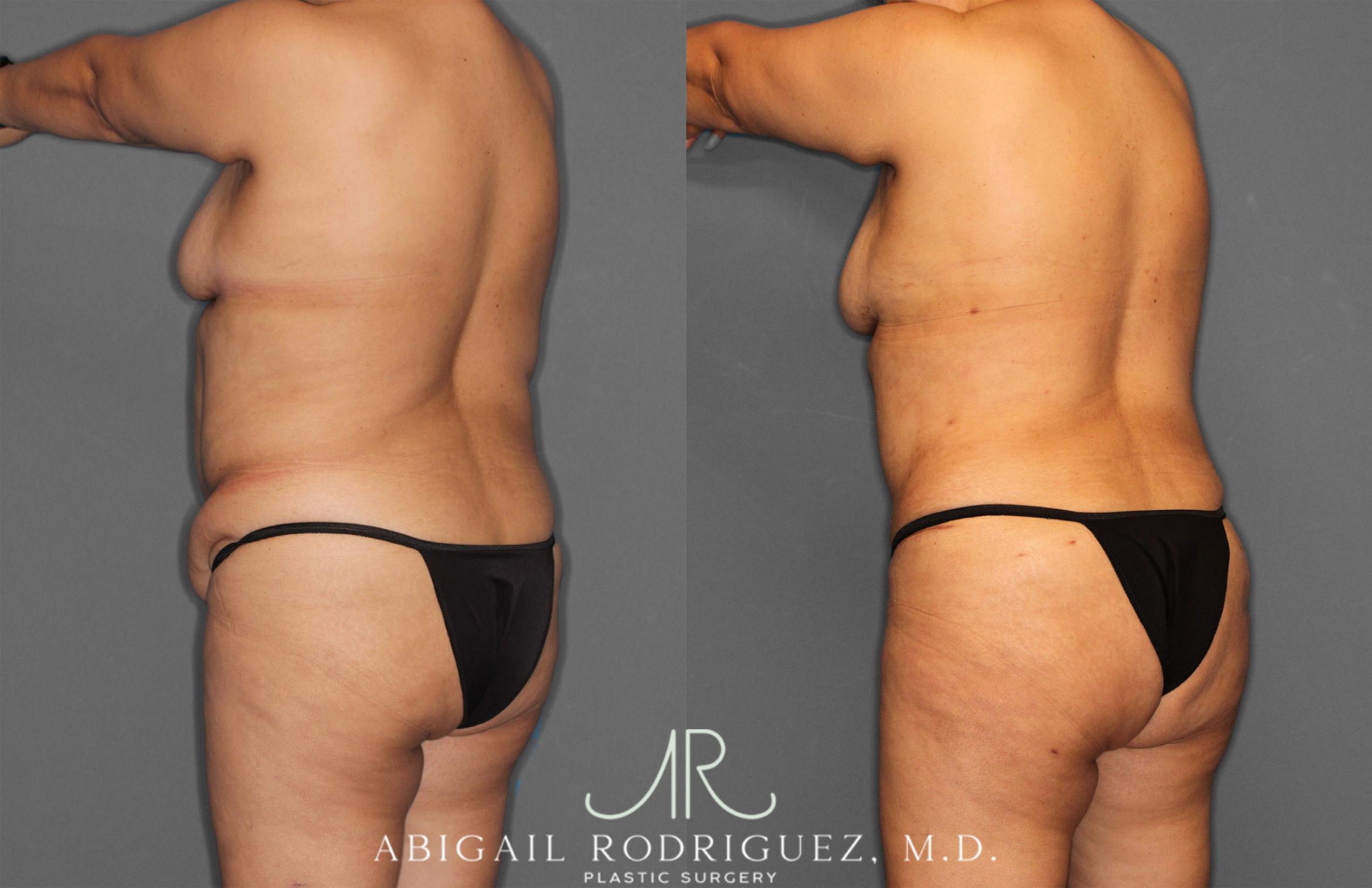 Before & After Tummy Tuck Case 258034 View 5 View in Houston, TX
