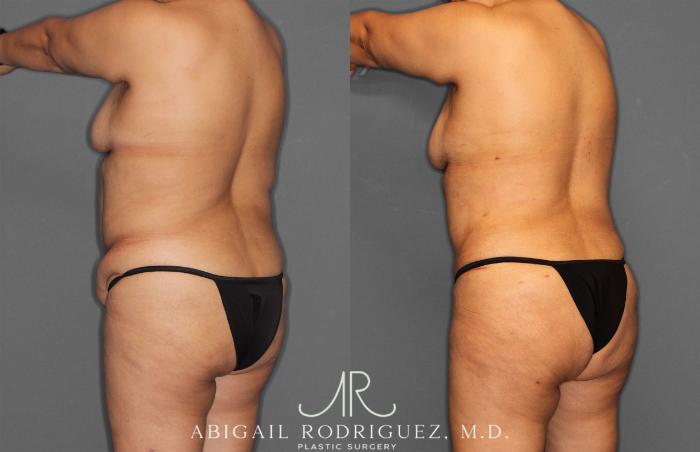 Before & After Tummy Tuck Case 258034 View 5 View in Houston, TX