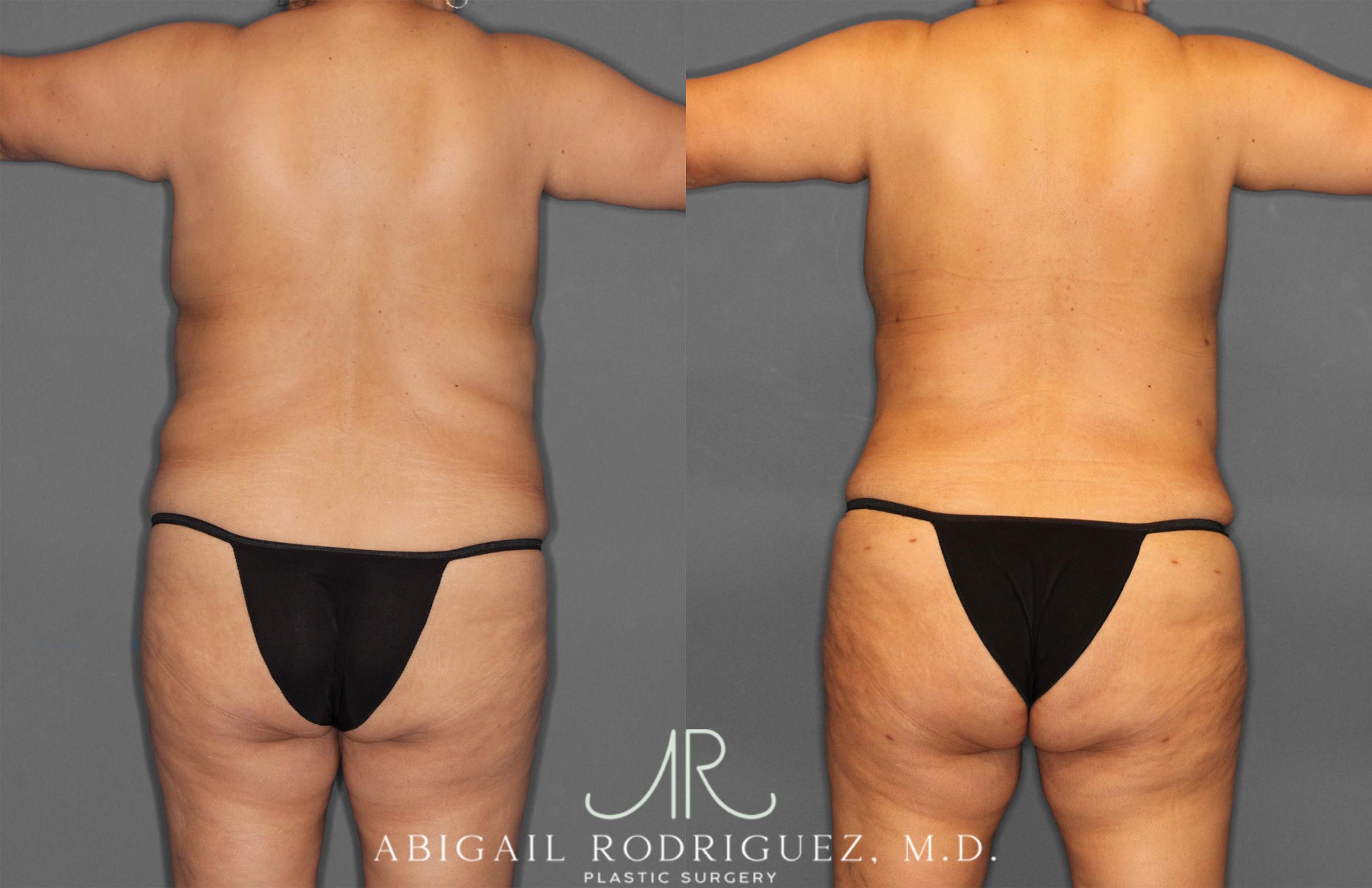 Before & After Tummy Tuck Case 258034 View 6 View in Houston, TX