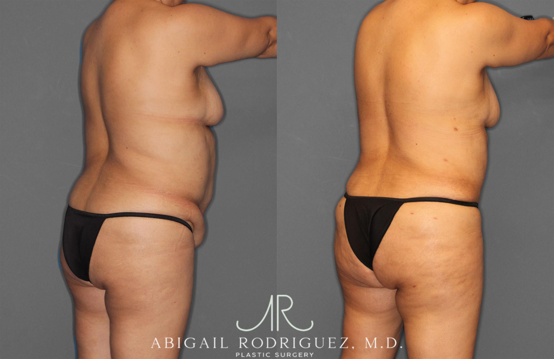 Before & After Tummy Tuck Case 258034 View 7 View in Houston, TX