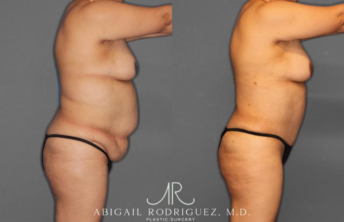 Before & After Tummy Tuck Case 258034 View 8 View in Houston, TX