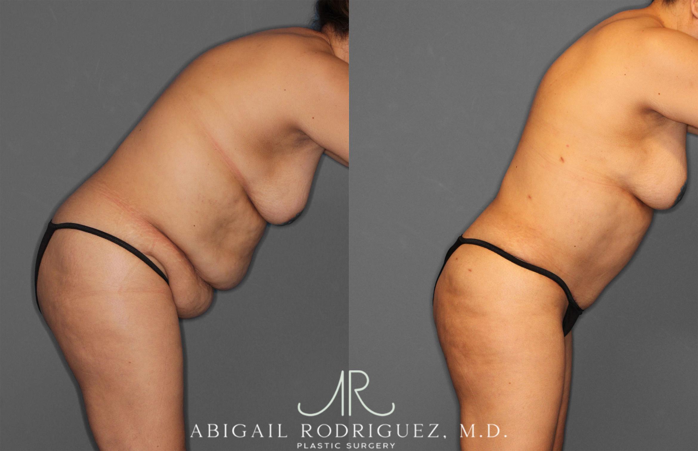 Before & After Tummy Tuck Case 258034 View 9 View in Houston, TX