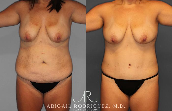 Before & After Tummy Tuck Case 258057 View 1 View in Houston, TX
