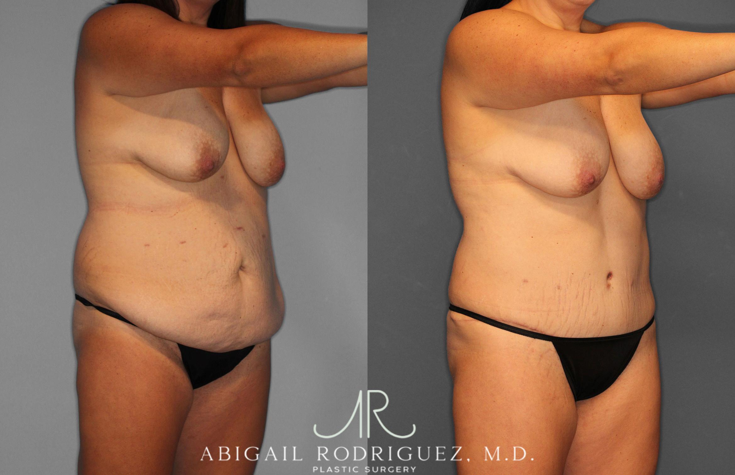 Before & After Tummy Tuck Case 258057 View 10 View in Houston, TX