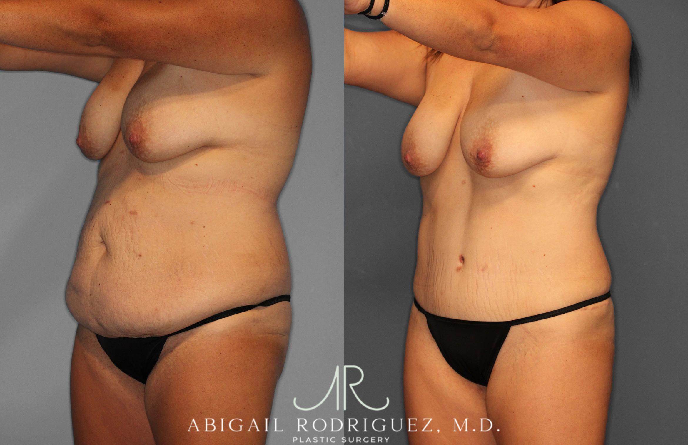 Before & After Tummy Tuck Case 258057 View 2 View in Houston, TX